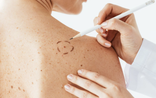 image.png Skin Tag Removal Course