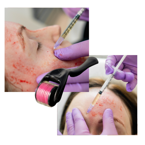 prp vampire facial